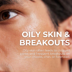 Oily Skin & Breakouts? Learn More